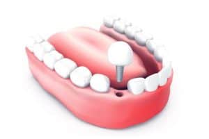 השתלת שיניים עם טיפולים נוספים לתוצאה מעולה לאורך זמן