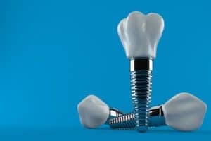 יתרונות שיטת השתלת שיניים ביום אחד